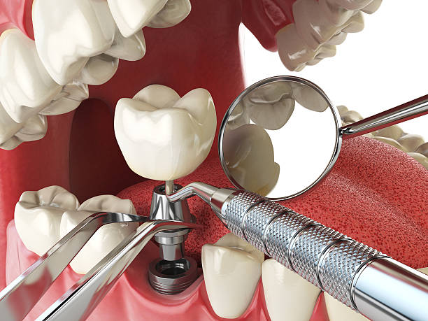 Best Emergency Tooth Extraction in Berkley, CO